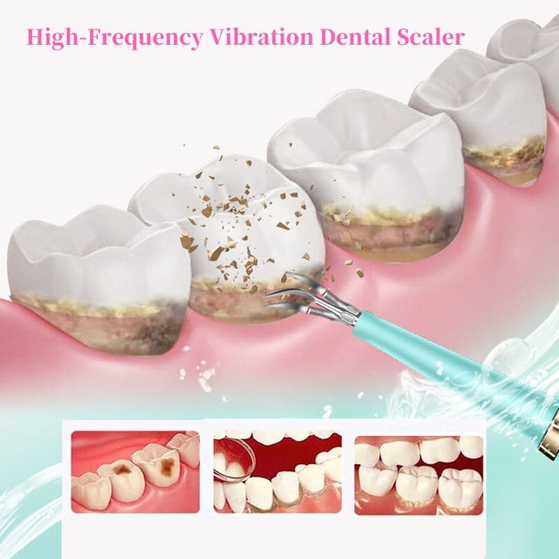 image-Portable Electric Sonic Dental Scaler Tooth Cleanser Dentist Calculus