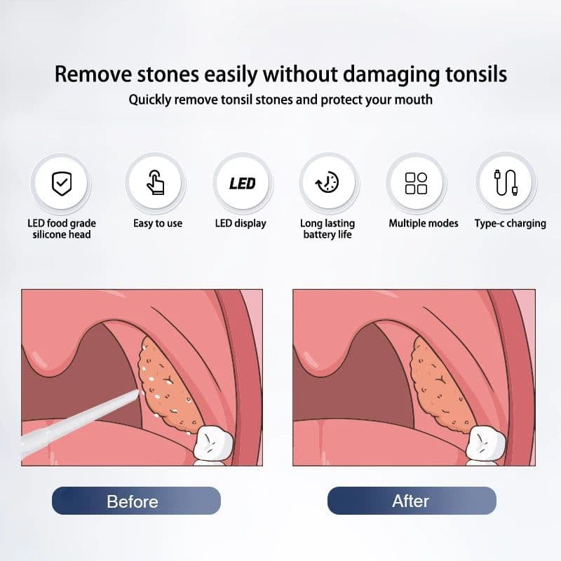 image-Electric Tonsil Stone Remover Tonsil Stone Removal Kit Vacuum