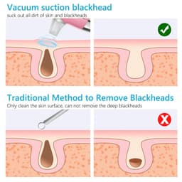 image-Facial Blackhead Remover Electric Acne Cleaner Device
