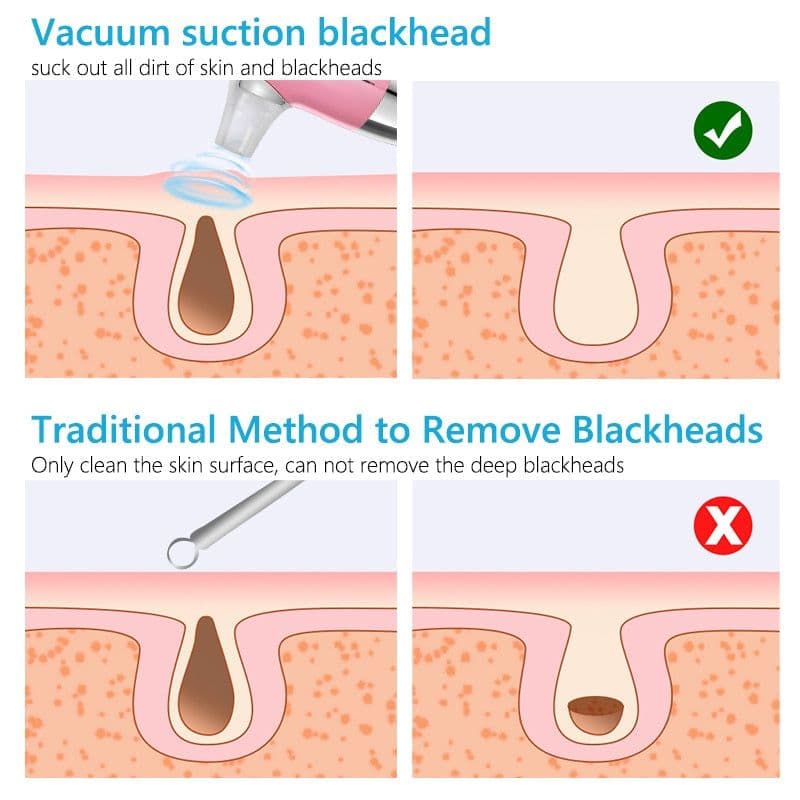 image-Facial Blackhead Remover Electric Acne Cleaner Device
