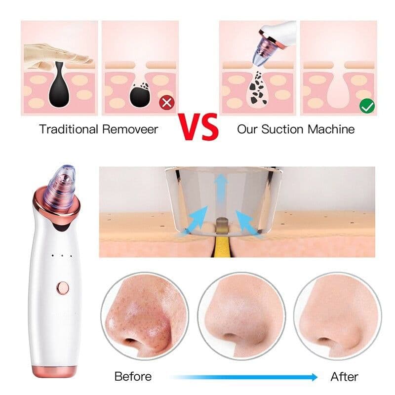 image-Vacuum Blackhead Remover Pimple Acne Removal Tool Skin Care Pore