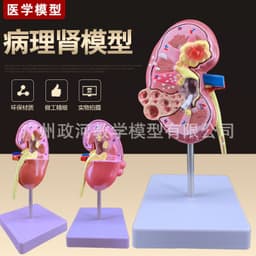 image-Diseased Kidney Model - PVC Anatomy Teaching Aid
