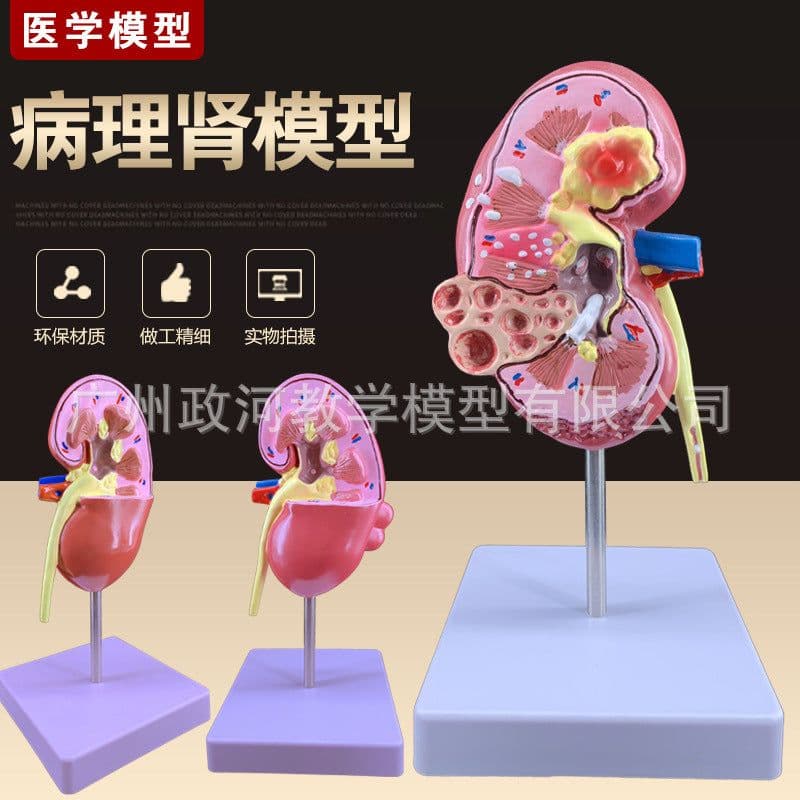 image-Diseased Kidney Model - PVC Anatomy Teaching Aid