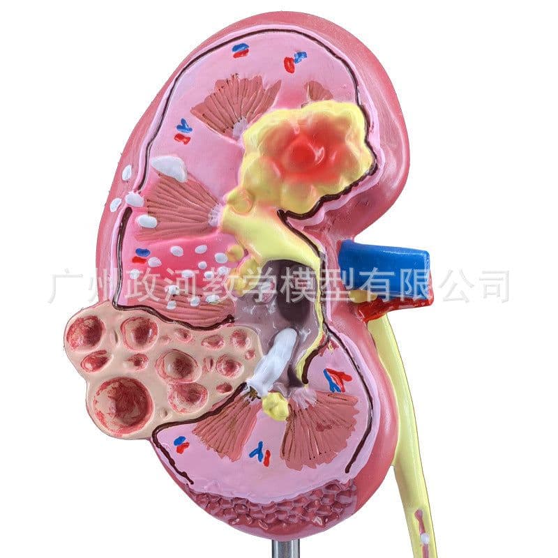 image-Diseased Kidney Model - PVC Anatomy Teaching Aid