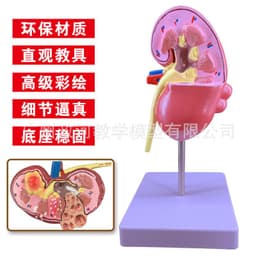image-Diseased Kidney Model - PVC Anatomy Teaching Aid