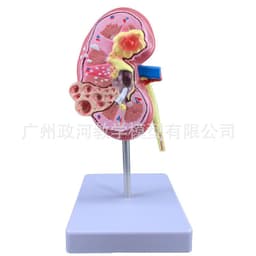 image-Diseased Kidney Model - PVC Anatomy Teaching Aid