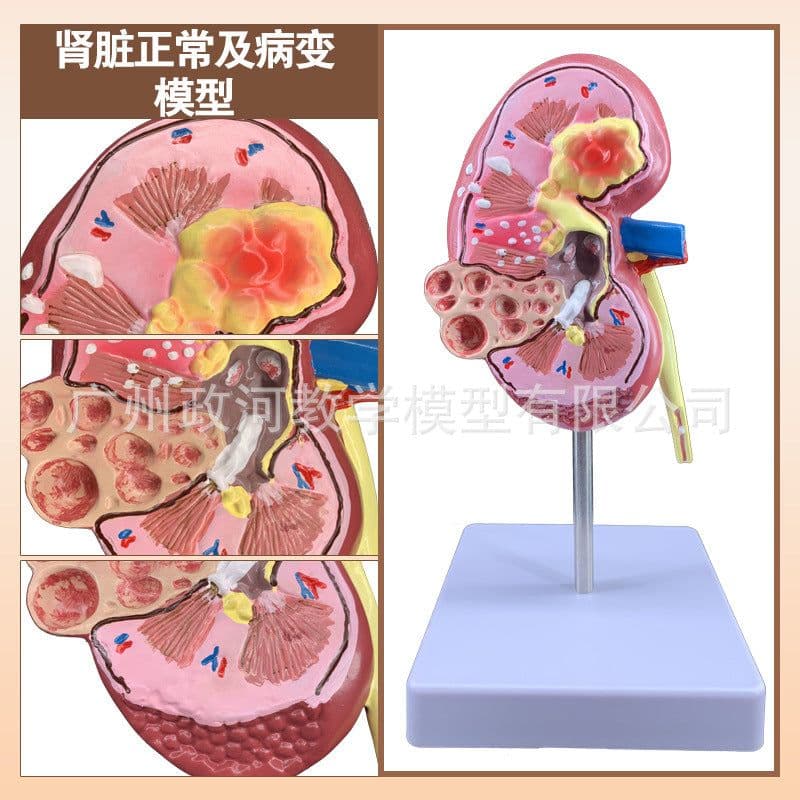 image-Diseased Kidney Model - PVC Anatomy Teaching Aid