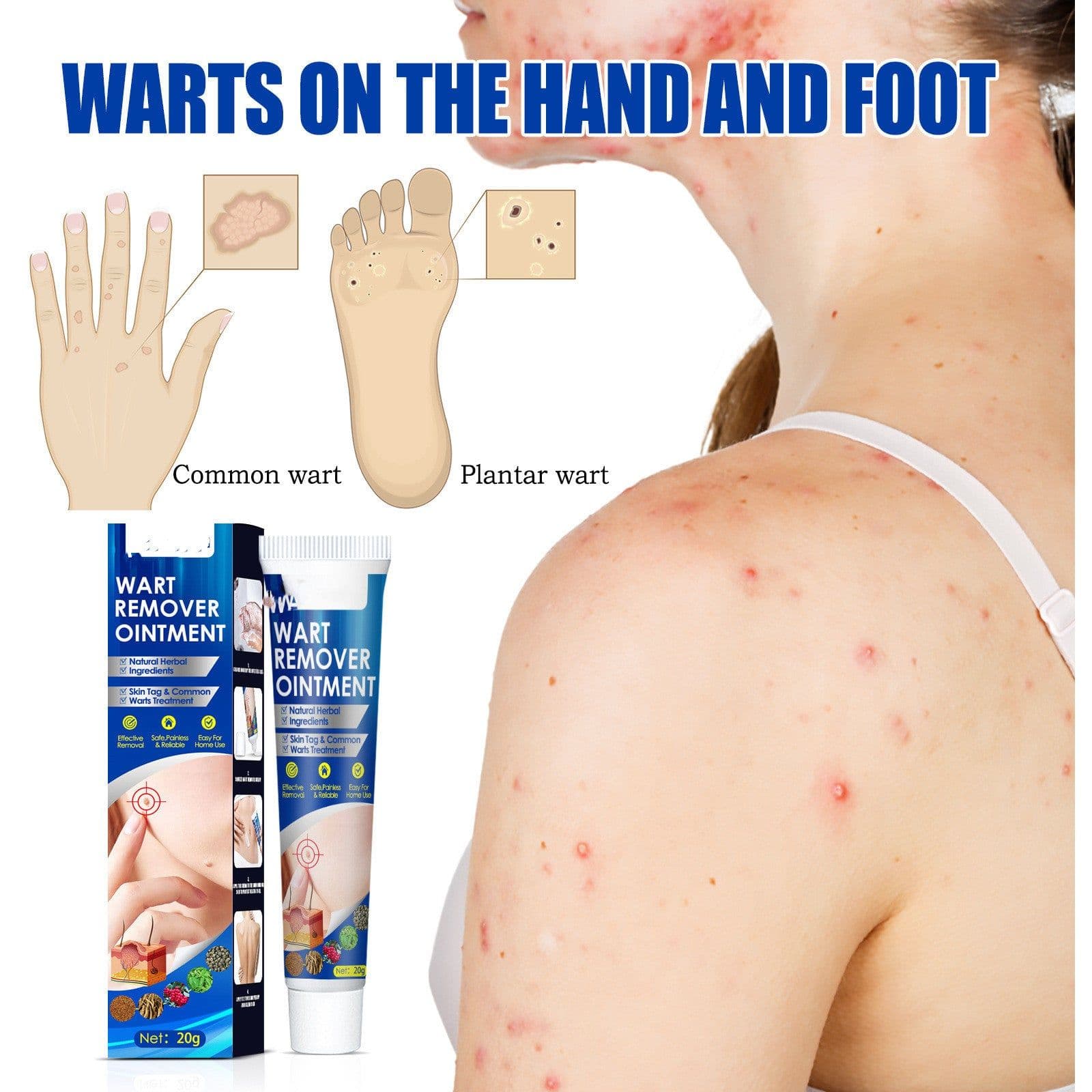 image-Hand Foot Face Underarm Wart Removing Cream