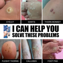 image-Hand Foot Face Underarm Wart Removing Cream