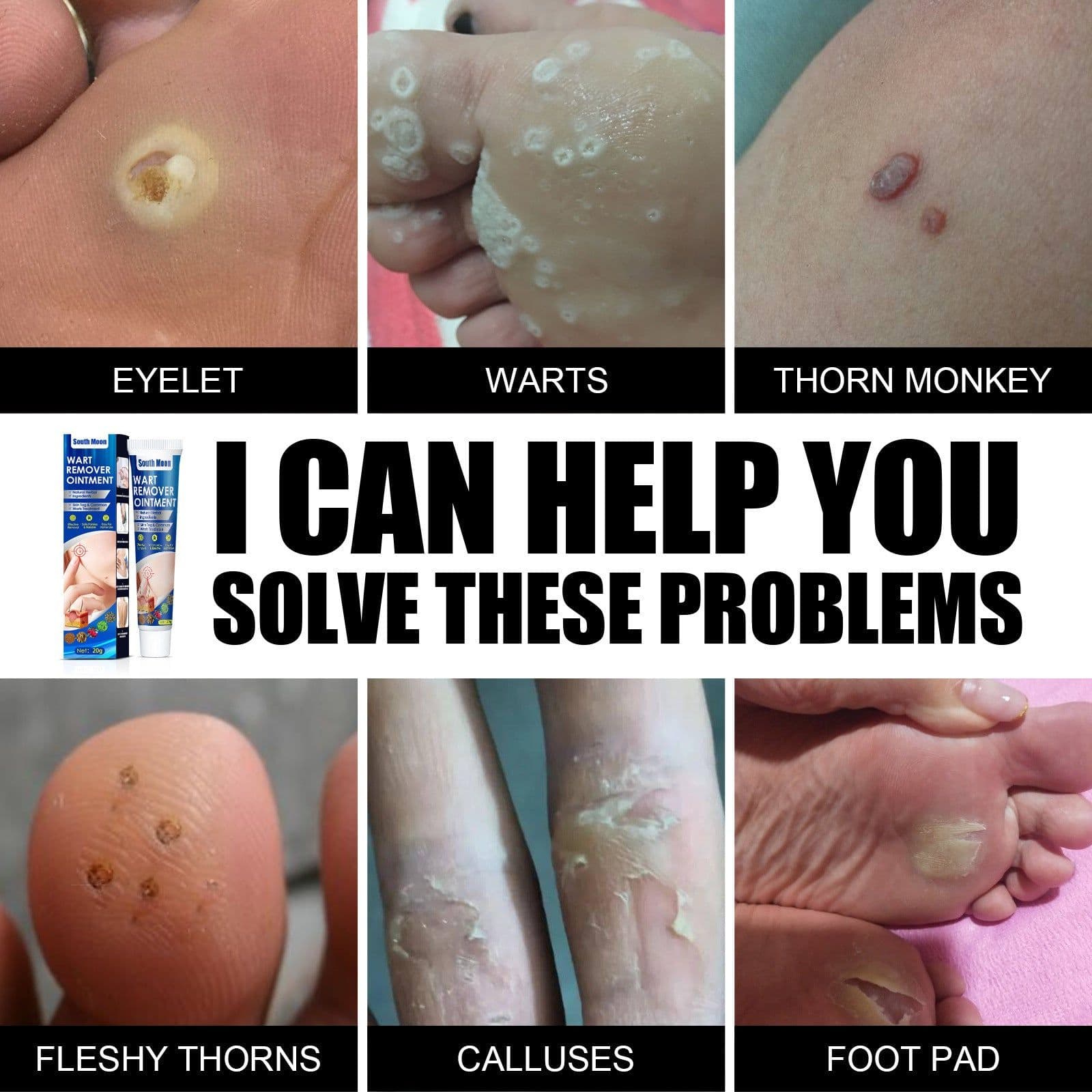 image-Hand Foot Face Underarm Wart Removing Cream