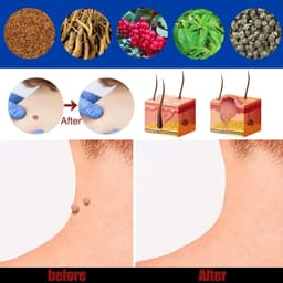 image-Hand Foot Face Underarm Wart Removing Cream