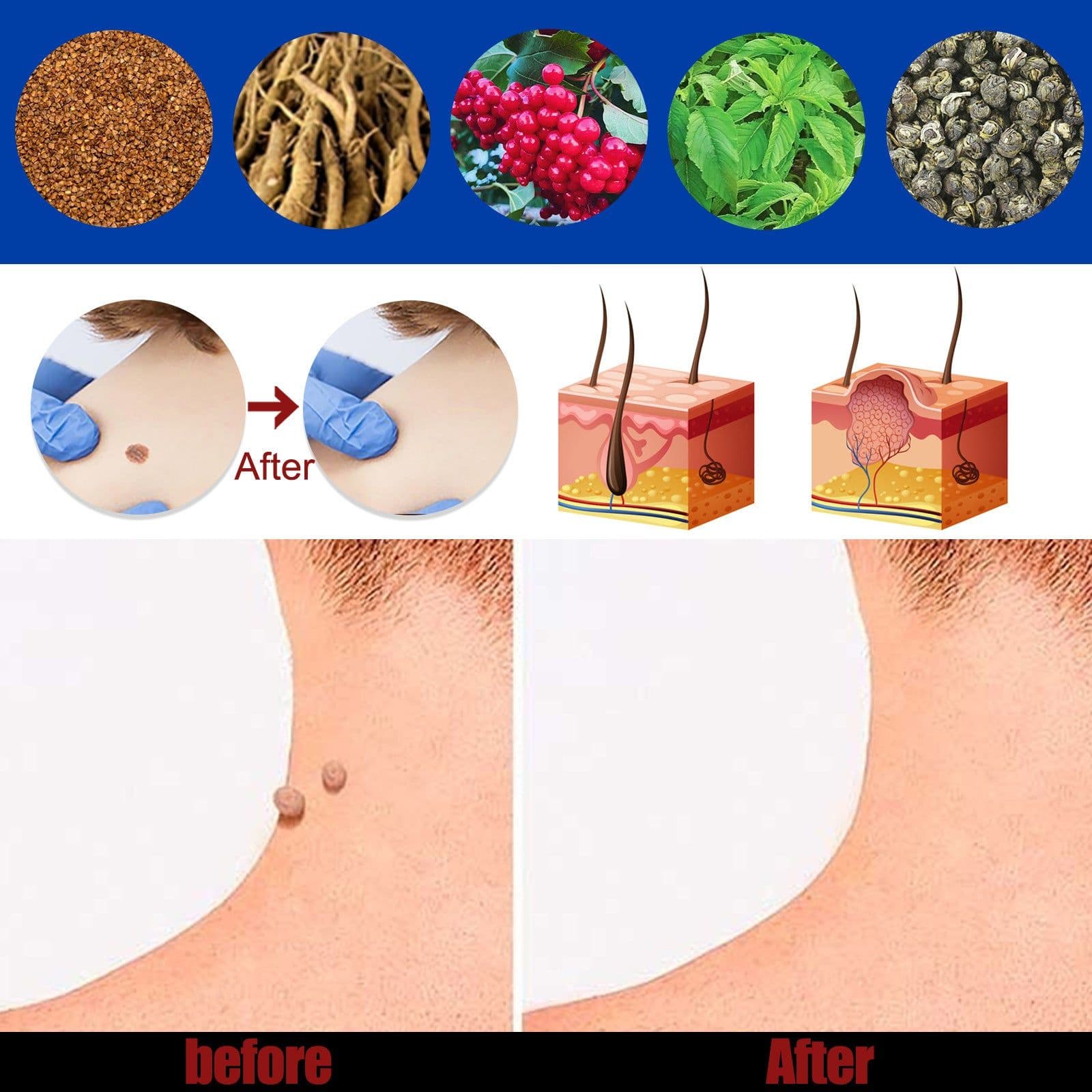 image-Hand Foot Face Underarm Wart Removing Cream
