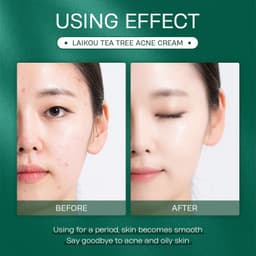 image-Tea Tree Anti Acne Face Cream 20g Moisturizing Skin Care Product