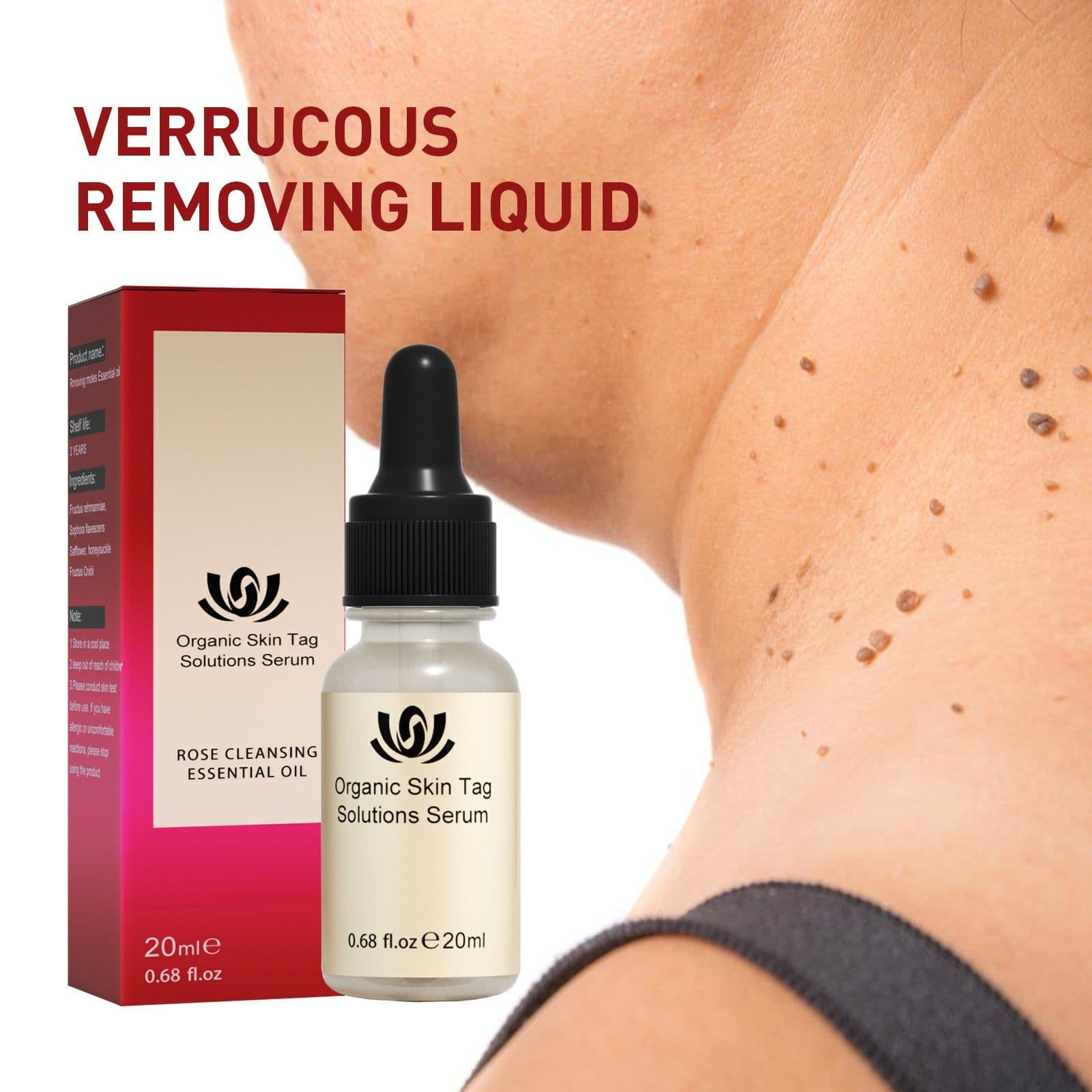 image-Wart Removal spotless black mole essential oil lightens the skin