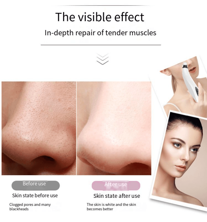image-Electric Blackhead Remover Cleaner Face Diamond Pore Vacuum Suction