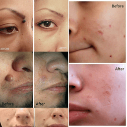 image-Electric Laser Plasma Pen Mole Removal Dark Spot Remover Skin Wart Tag