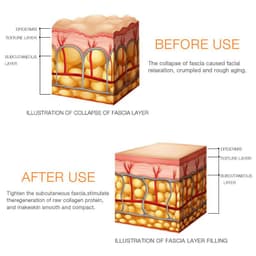 image-Glomeve Mini HIFU Ultrasonic Lifting RF Beauty Device