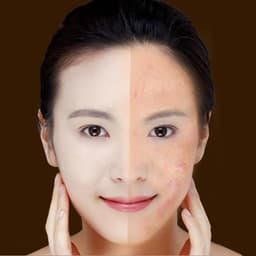 image-Blue Light Therapy Acne Laser Pen Soft Scar Wrinkle Removal Treatment Device Skin Care Beauty Equipment