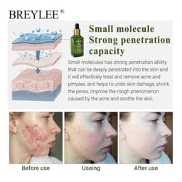 image-BREYLEE Acne Treatment Serum Face Facial Anti Acne Scar Removal Cream Skin Care Whitening Repair Pimple Remover For Acne