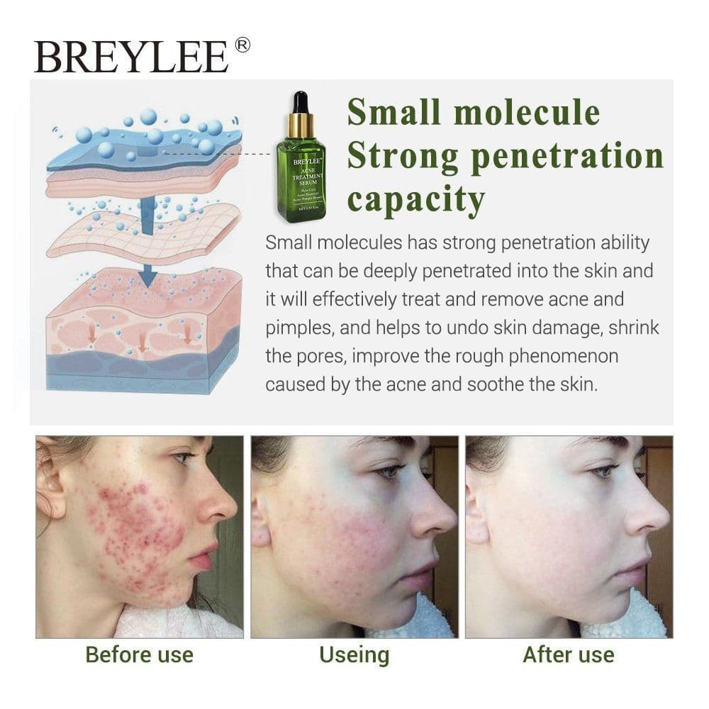 image-BREYLEE Acne Treatment Serum Face Facial Anti Acne Scar Removal Cream Skin Care Whitening Repair Pimple Remover For Acne