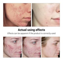 image-BREYLEE Acne Treatment Serum Face Facial Anti Acne Scar Removal Cream Skin Care Whitening Repair Pimple Remover For Acne