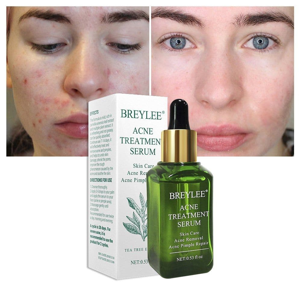 image-BREYLEE Acne Treatment Serum Face Facial Anti Acne Scar Removal Cream Skin Care Whitening Repair Pimple Remover For Acne