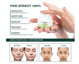 image-Men's and Women's Oil Control Acne Cream