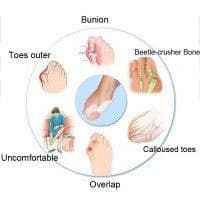image-1 Pair Silicone Foot Care Hallux Valgus Corrector