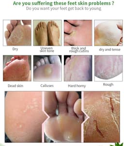 image-Foot peel mask