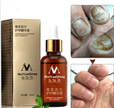 image-Fungal Nail Treatment Feet Care Nail Foot Whitening Toe Nail Fungus Removal Gel Anti Infection Paronychia Onychomycosis