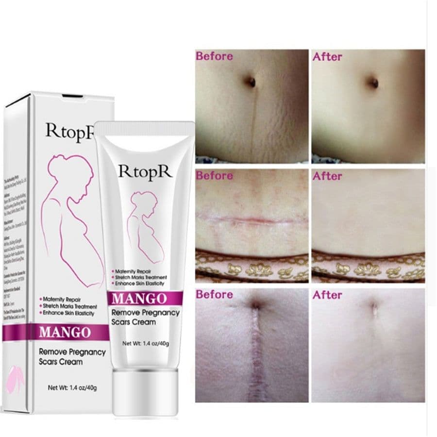 image-Natural Mild Non-irritating Mango Remove Stretch Mark Cream For Pregnancy Repair Scar Slack Line Abdomen Stretch Marks Cream
