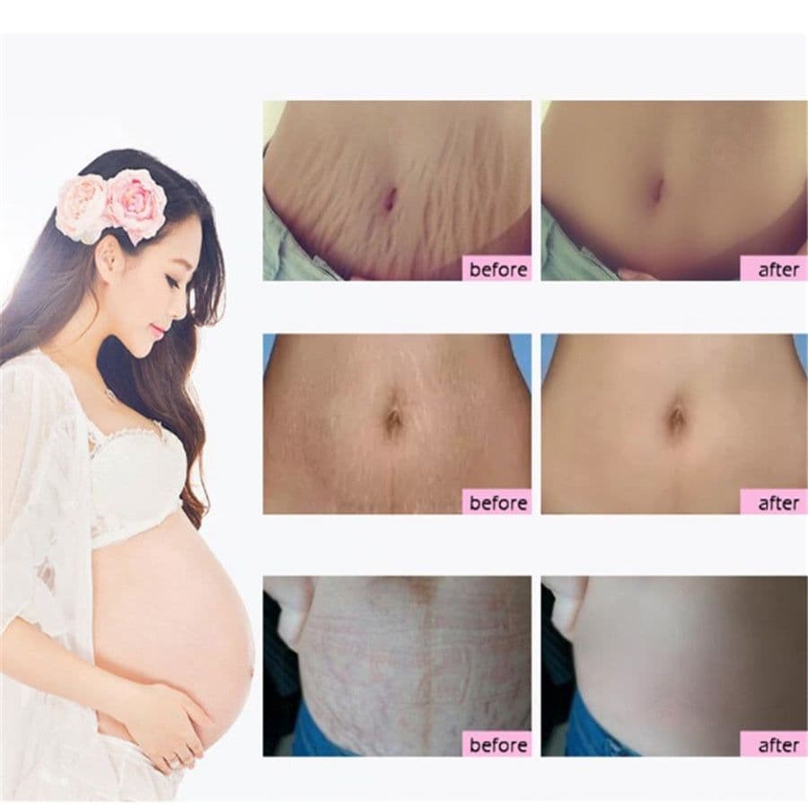 image-Natural Mild Non-irritating Mango Remove Stretch Mark Cream For Pregnancy Repair Scar Slack Line Abdomen Stretch Marks Cream
