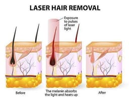 image-Laser hair removal device