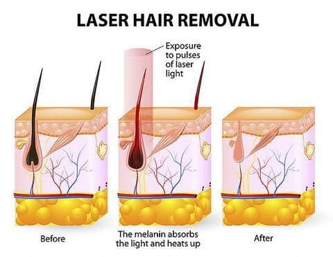 image-Laser hair removal device