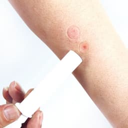 image-Plastic Bug Bite Thing Suction