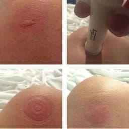 image-Plastic Bug Bite Thing Suction