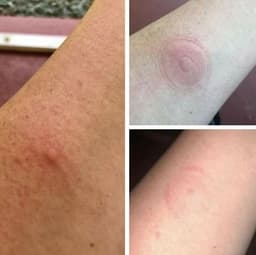 image-Plastic Bug Bite Thing Suction