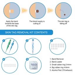 image-Skin Tag Removal Kit Home Use Mole Wart Remover Equipment Micro Skin Tag Treatment Tool Easy To Clean Skin Care Tool