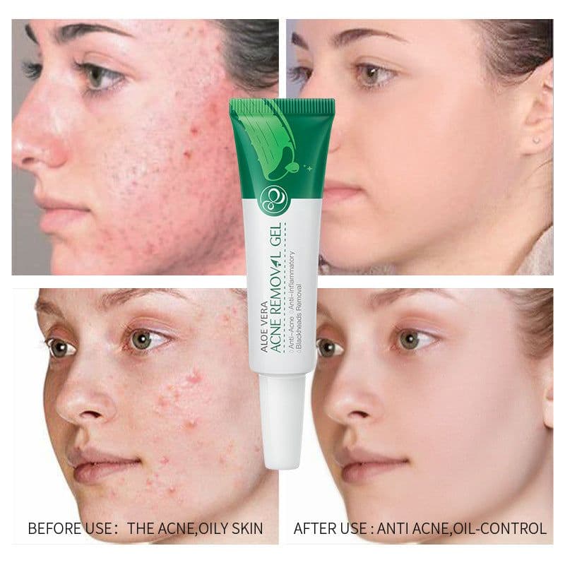 image-Aloe Acne Treatment Gel Face Cream Serum Anti Acne Scar Cream Shrink Pores Moisturizing Oil Control Soothing Skin Care