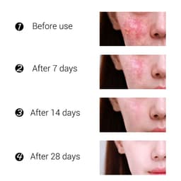 image-BREYLEE Tea Tree Acne Cream Moisturizing Acne Scars Scar Cream