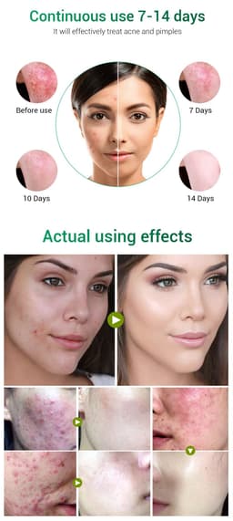image-BREYLEE Tea Tree Acne Cream Moisturizing Acne Scars Scar Cream