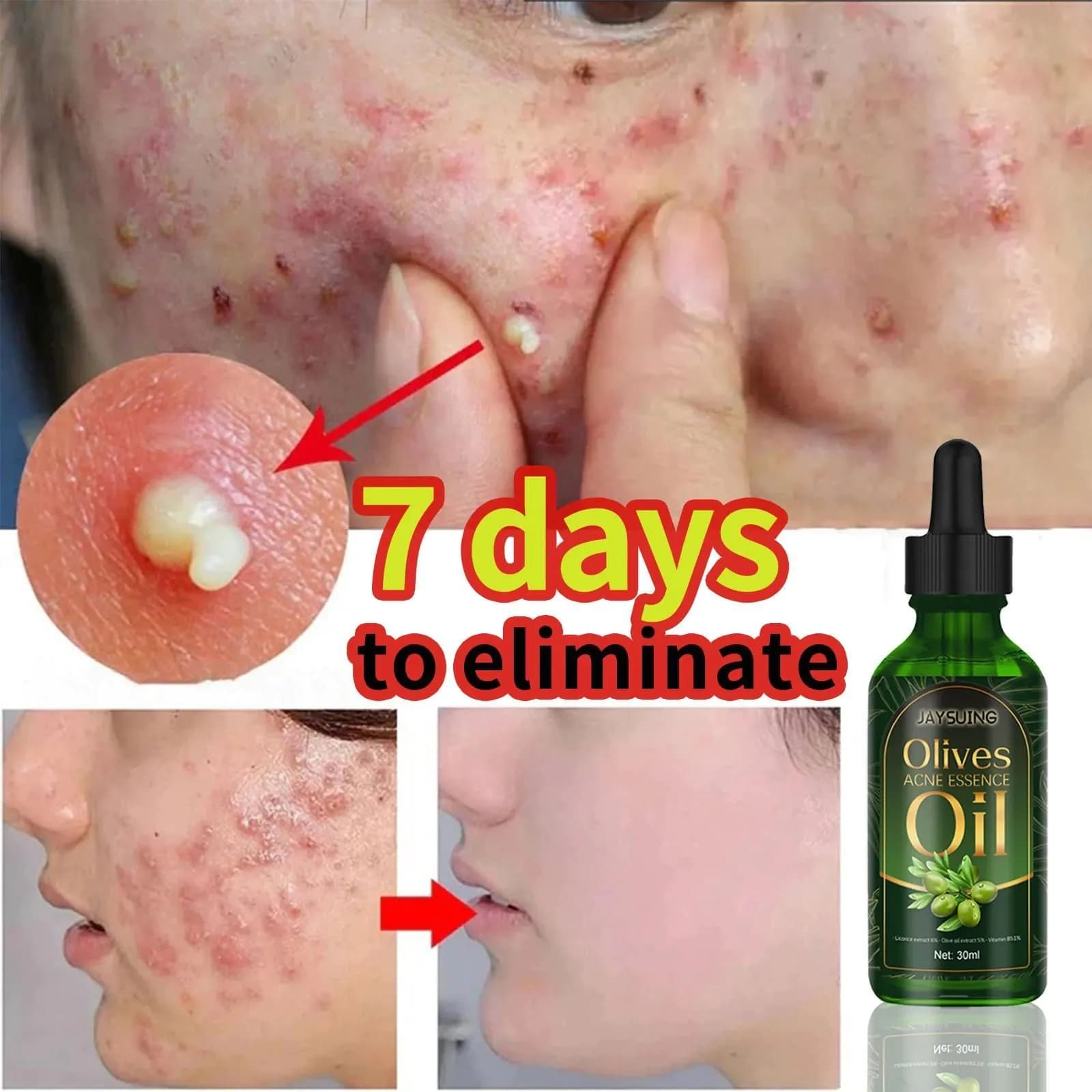 image-Remove Face Oil Acne Gentle Moisturizing Acne Pit Repair Liquid Fade Face Acne Marks Essential Oil