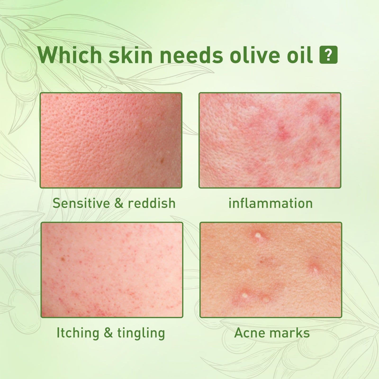 image-Remove Face Oil Acne Gentle Moisturizing Acne Pit Repair Liquid Fade Face Acne Marks Essential Oil