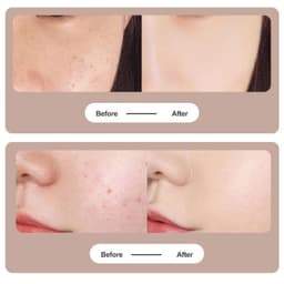 image-Tattoo Mole Removal Plasma Pen Laser Facial Freckle Dark Spot Remover Tool Wart Removal Machine Face Skin Care Beauty Device