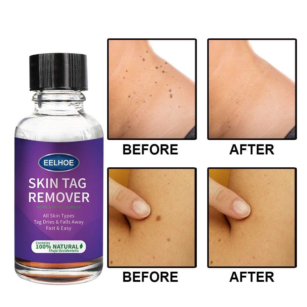 image-Foreign Trade Cross-Border Eelhoe Skin Verrucous Remover To Solve Skin Verrucous