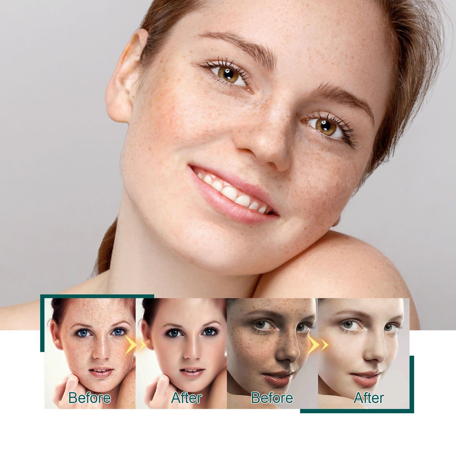 image-Brightening And Lightening Melasma Blemish Moisturizing And Brightening Skin