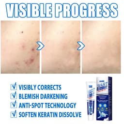 image-Warts Remover Antibacterial Ointment Wart Treatment Cream Skin Tag Remover Herbal Extract Corn Plaster Warts Ointment