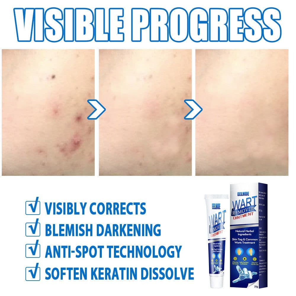 image-Warts Remover Antibacterial Ointment Wart Treatment Cream Skin Tag Remover Herbal Extract Corn Plaster Warts Ointment