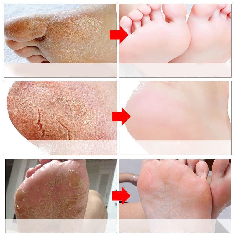 image-Lavender Rose Foot Mask Dead Skin Calluses Horny Foot Mask
