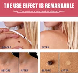 image-Cure Warts Remove Moles Face And Neck Filamentous Warts Body Cleaning Soap